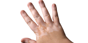 Cures for Vitiligo – Vitiligo Treatment Options