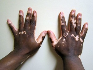 How to Cure Vitiligo