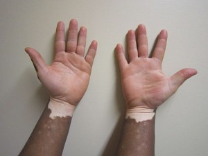 Vitiligo Cure – Information to Cure Vitiligo